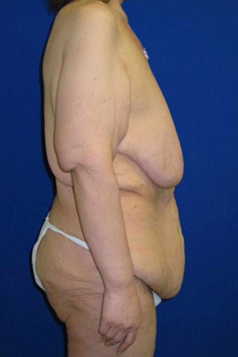 Panniculectomy Before & After Gallery - Patient 175169448 - Image 3