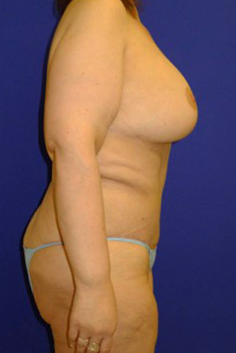 Panniculectomy Before & After Gallery - Patient 175169448 - Image 4