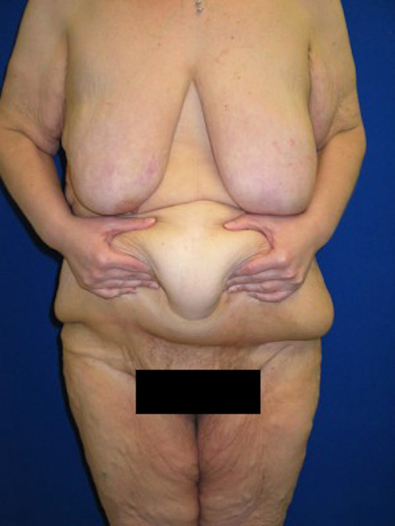 Panniculectomy Before & After Gallery - Patient 175169448 - Image 5