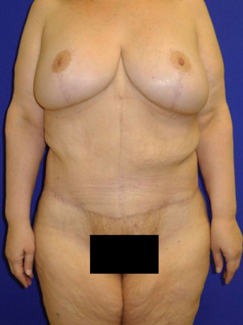 Panniculectomy Before & After Gallery - Patient 175169448 - Image 6