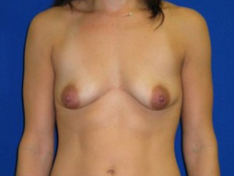 Augmentation Before & After Gallery - Patient 175169451 - Image 1