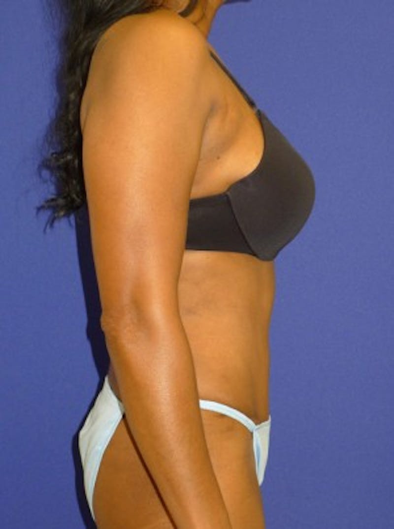 Abdominoplasty Before & After Gallery - Patient 175169457 - Image 4