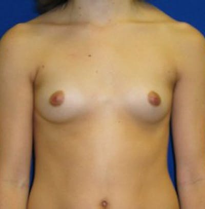 Augmentation Before & After Gallery - Patient 175169459 - Image 1