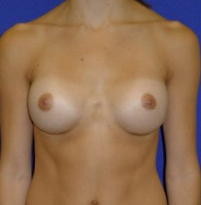 Augmentation Before & After Gallery - Patient 175169459 - Image 2