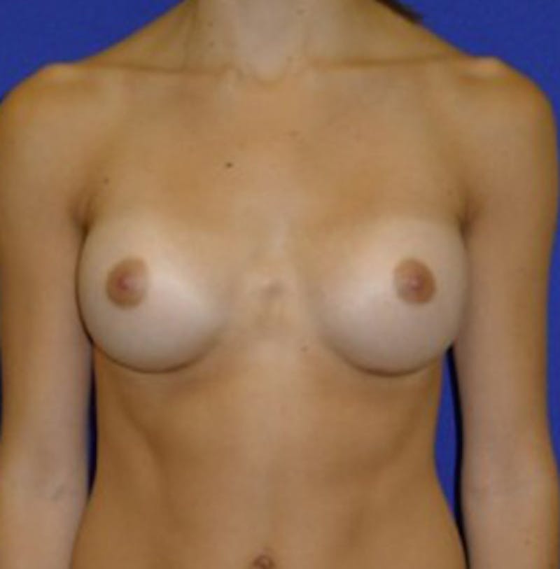 Augmentation Before & After Gallery - Patient 175169459 - Image 2