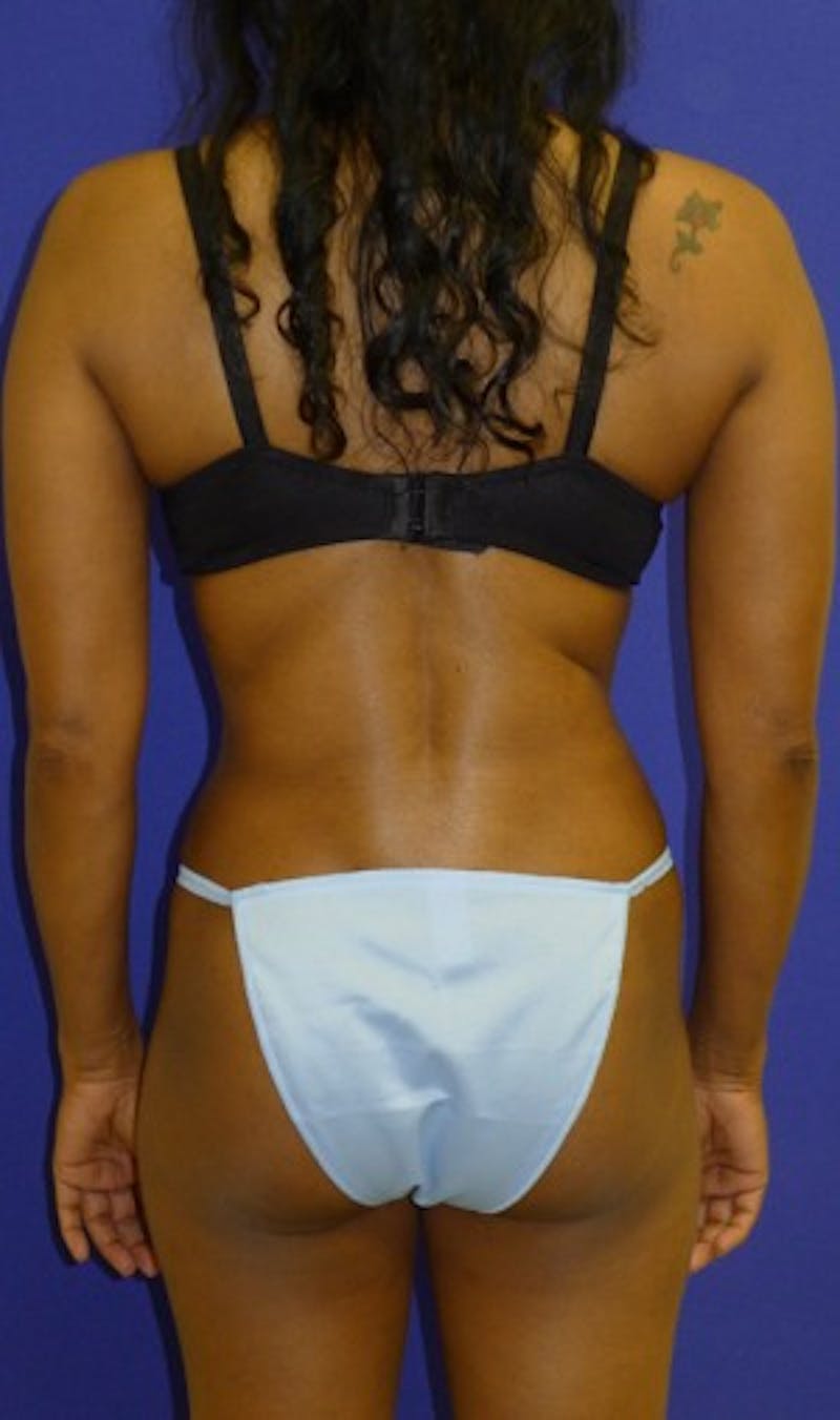 Abdominoplasty Before & After Gallery - Patient 175169457 - Image 6