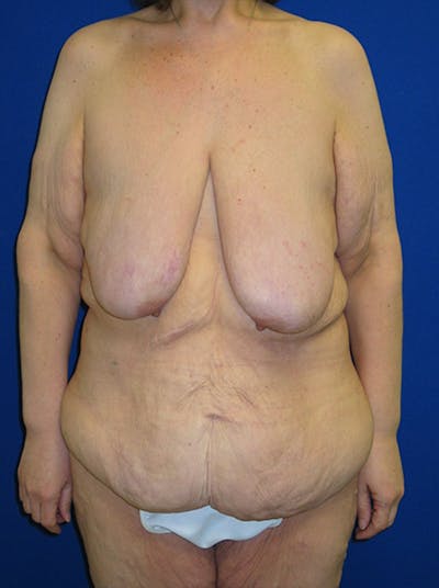 Breast Before & After Gallery - Patient 175169462 - Image 1