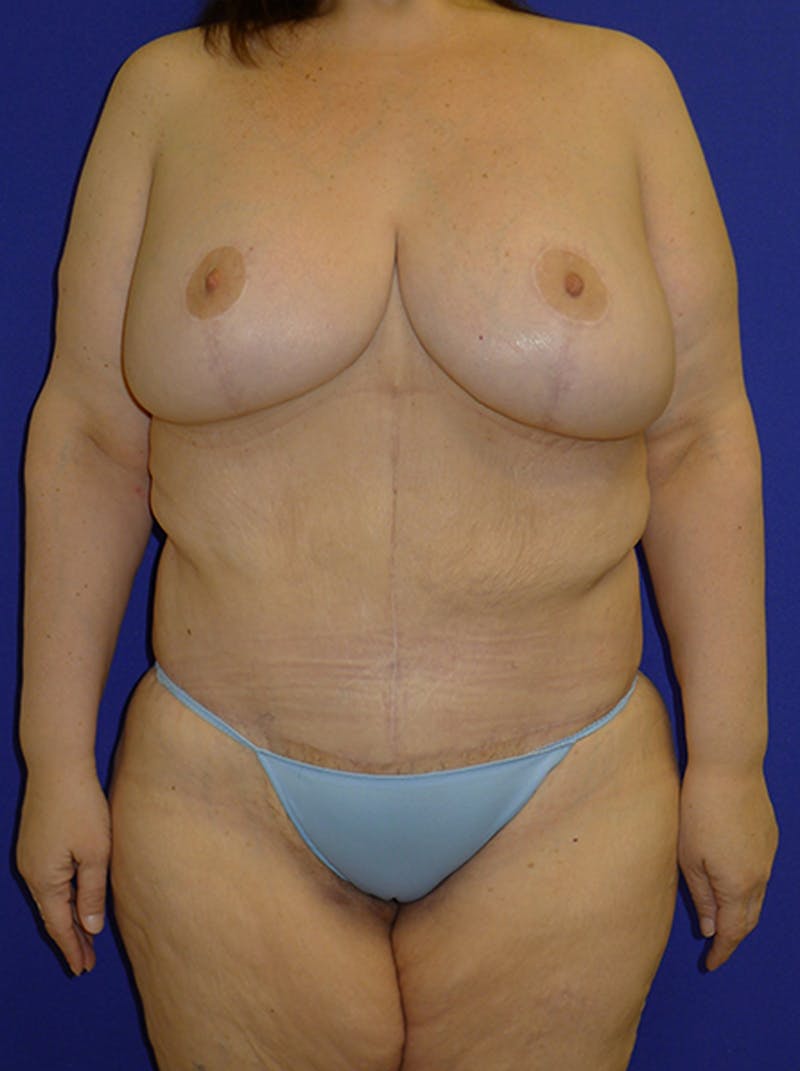 Breast Before & After Gallery - Patient 175169462 - Image 2