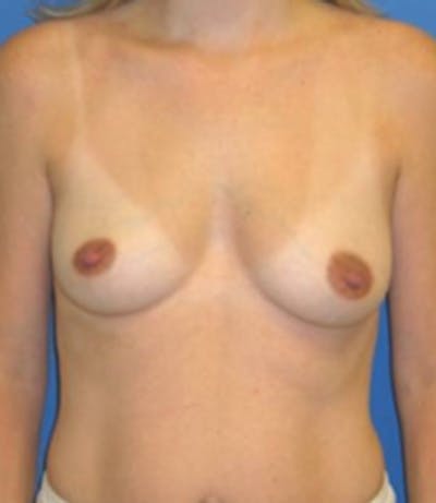 Augmentation Before & After Gallery - Patient 175169461 - Image 1