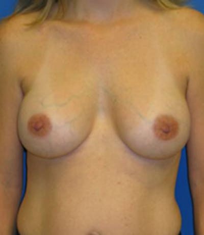 Augmentation Before & After Gallery - Patient 175169461 - Image 2