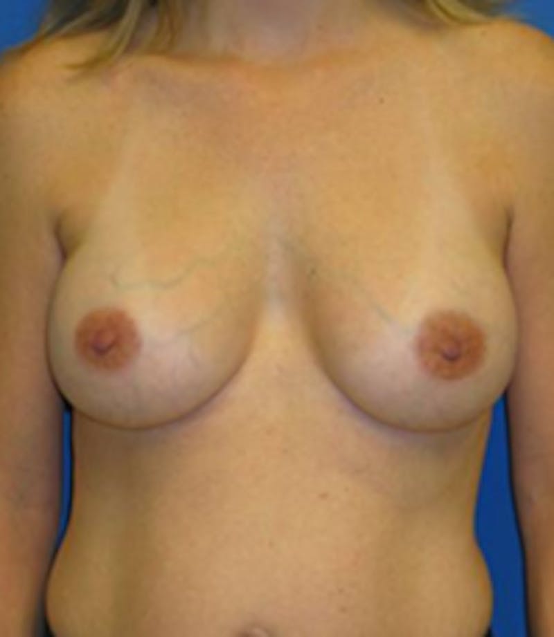 Augmentation Before & After Gallery - Patient 175169461 - Image 2