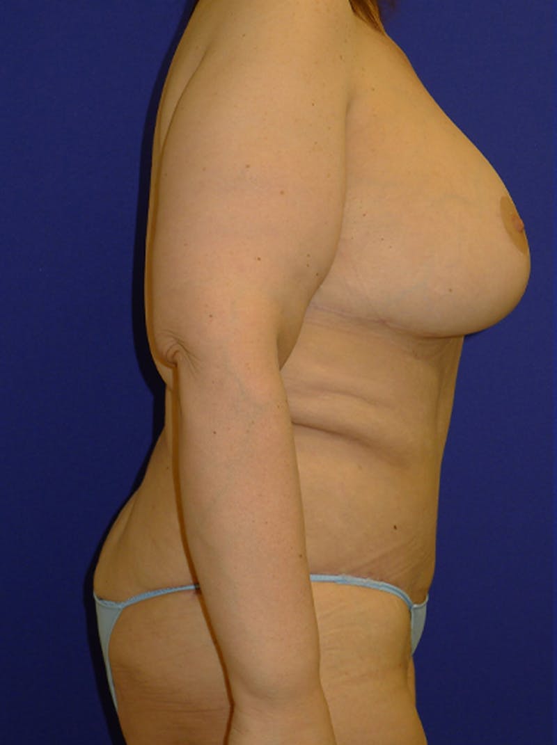 Breast Before & After Gallery - Patient 175169462 - Image 3
