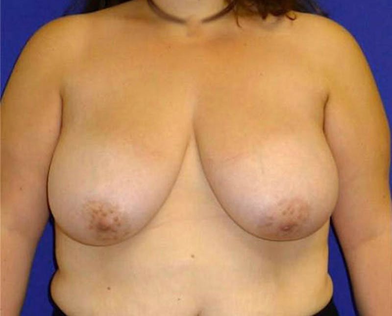 Reduction Before & After Gallery - Patient 175169464 - Image 1