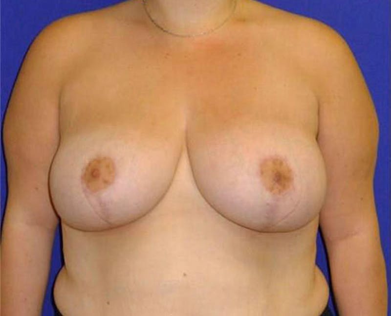Reduction Before & After Gallery - Patient 175169464 - Image 2