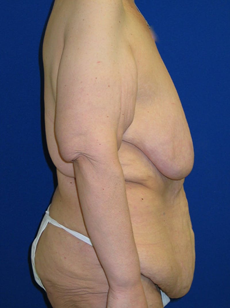 Breast Before & After Gallery - Patient 175169462 - Image 4
