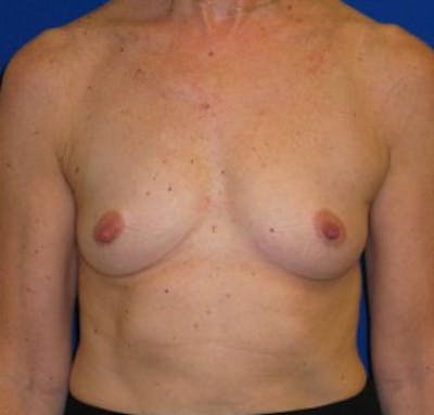 Augmentation Before & After Gallery - Patient 175169465 - Image 1