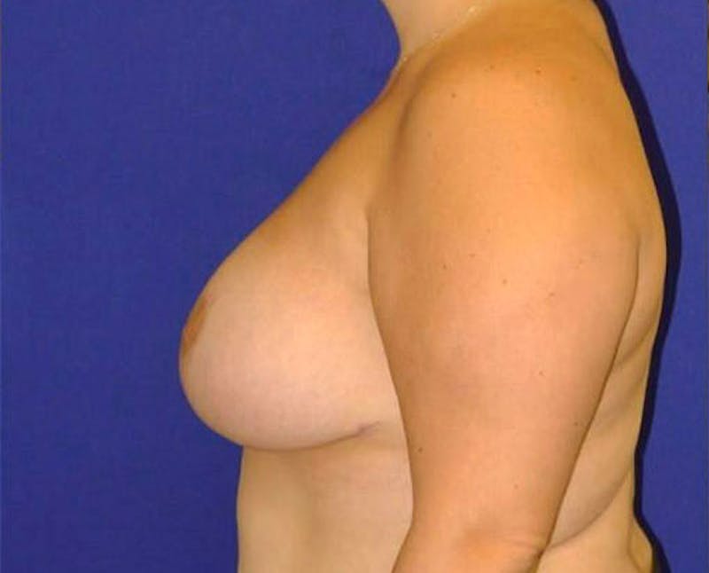 Reduction Before & After Gallery - Patient 175169464 - Image 4