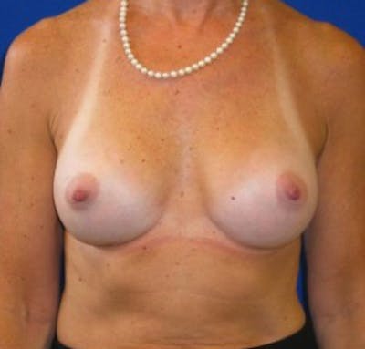 Augmentation Before & After Gallery - Patient 175169465 - Image 2