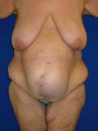Panniculectomy Before & After Gallery - Patient 175169478 - Image 1