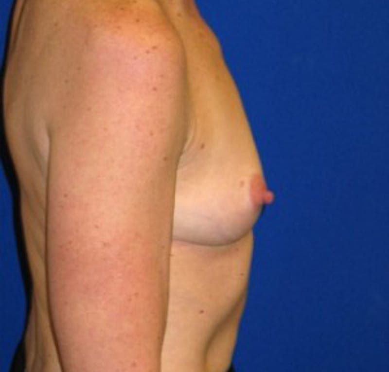 Augmentation Before & After Gallery - Patient 175169465 - Image 3