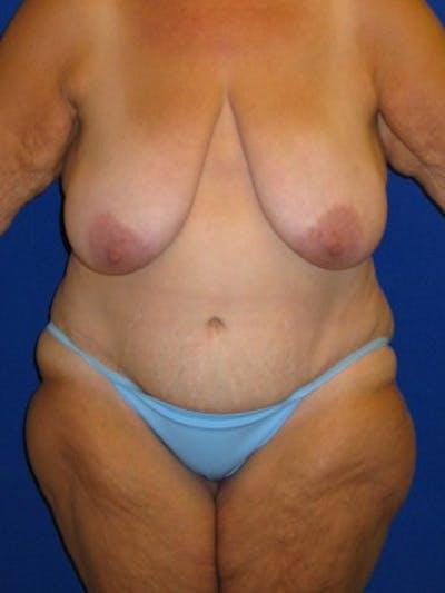 Panniculectomy Before & After Gallery - Patient 175169478 - Image 2