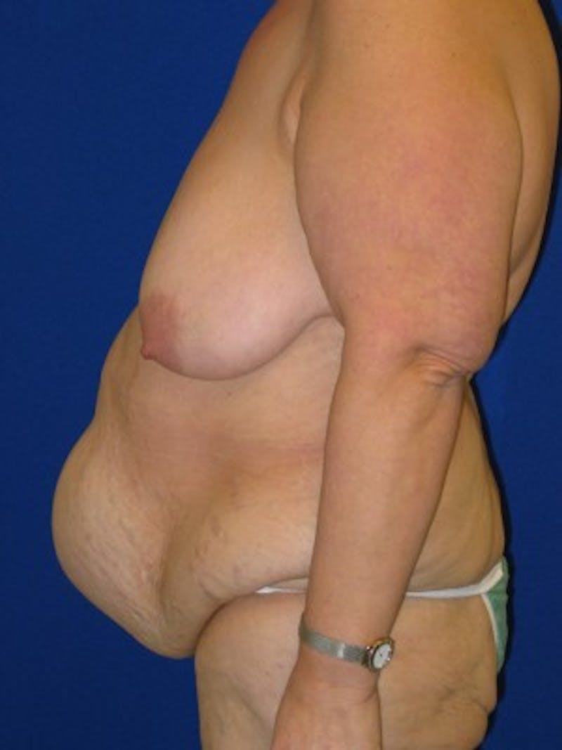 Panniculectomy Before & After Gallery - Patient 175169478 - Image 5