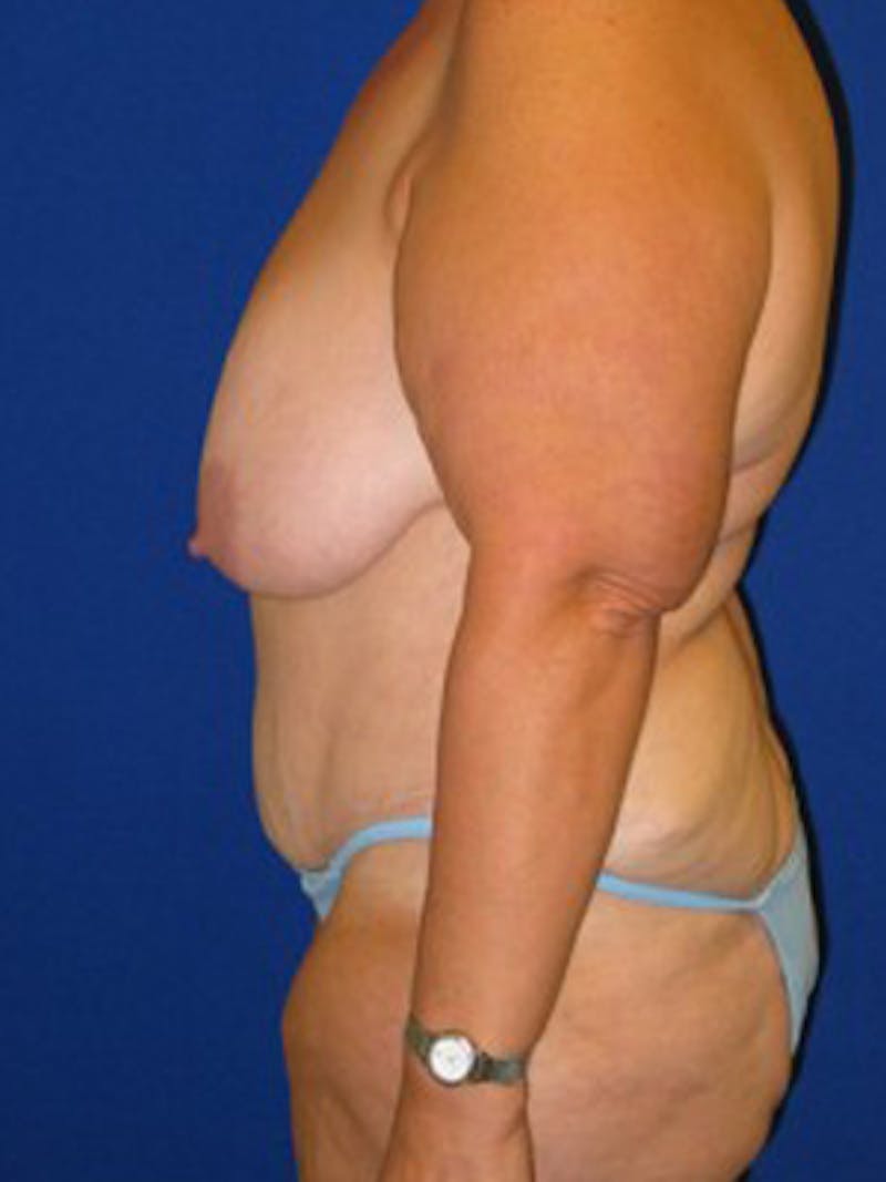 Panniculectomy Before & After Gallery - Patient 175169478 - Image 6