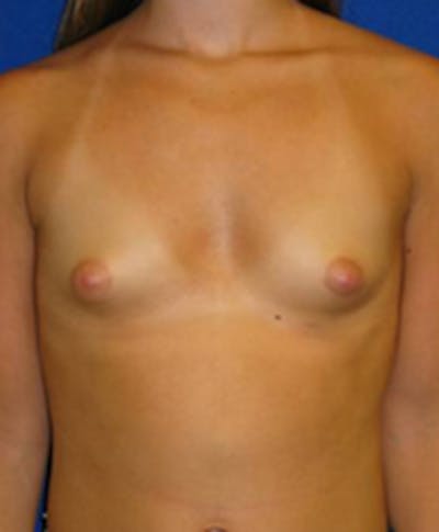 Augmentation Before & After Gallery - Patient 175169594 - Image 1