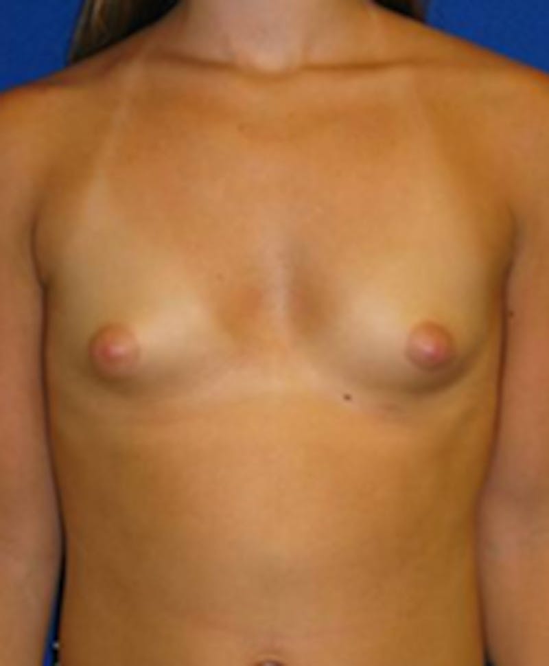 Augmentation Before & After Gallery - Patient 175169594 - Image 1