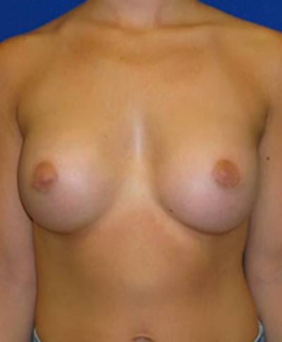 Augmentation Before & After Gallery - Patient 175169594 - Image 2