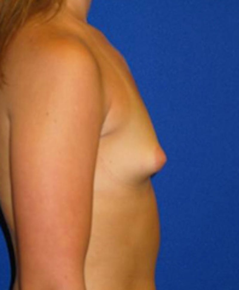 Augmentation Before & After Gallery - Patient 175169594 - Image 3