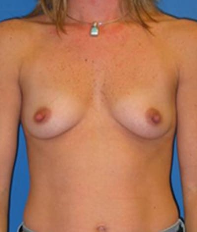 Augmentation Before & After Gallery - Patient 175169597 - Image 1