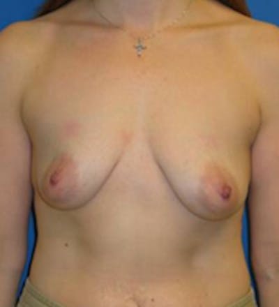 Augmentation Before & After Gallery - Patient 175169604 - Image 1