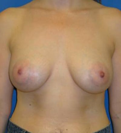 Augmentation Before & After Gallery - Patient 175169604 - Image 2