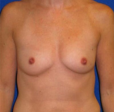 Augmentation Before & After Gallery - Patient 175169608 - Image 1
