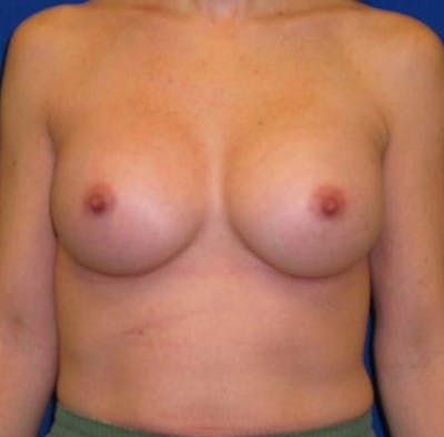 Augmentation Before & After Gallery - Patient 175169608 - Image 2