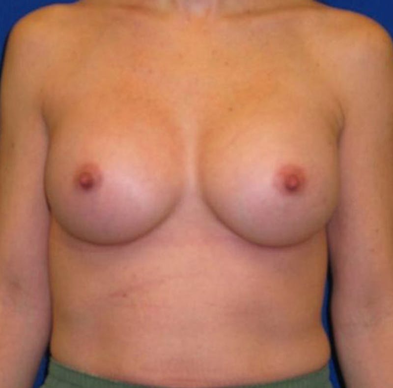 Augmentation Before & After Gallery - Patient 175169608 - Image 2