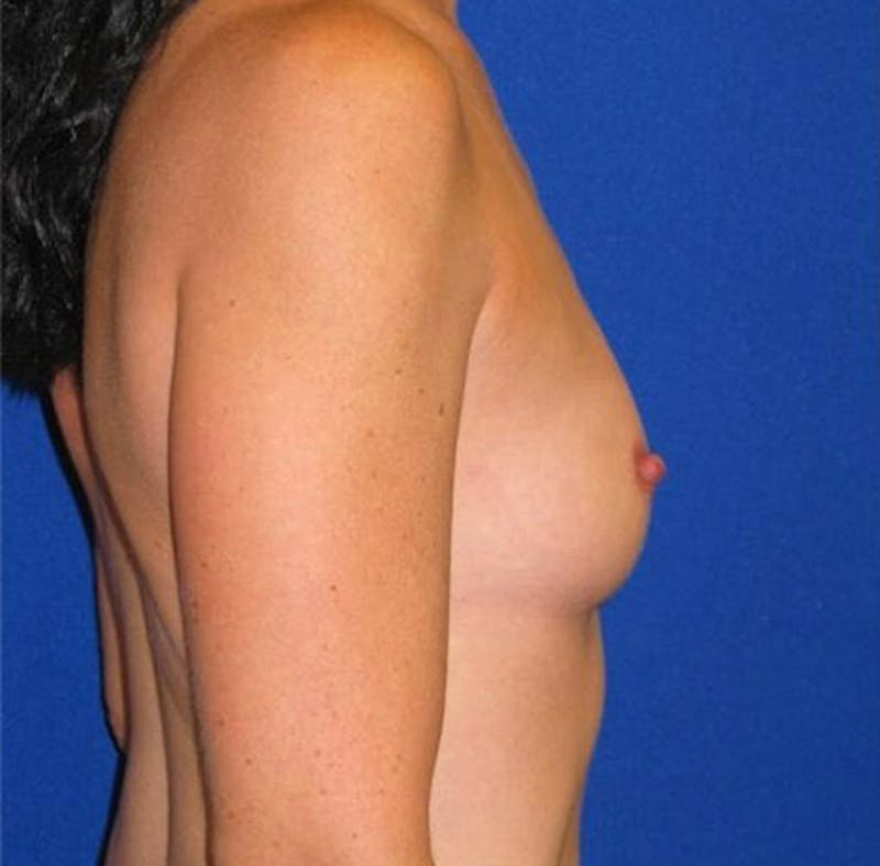 Augmentation Before & After Gallery - Patient 175169608 - Image 3