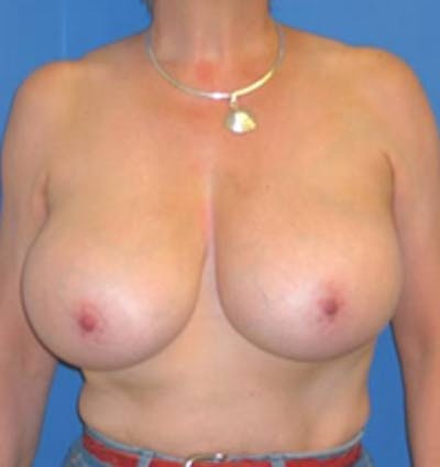Reduction Before & After Gallery - Patient 175169627 - Image 1