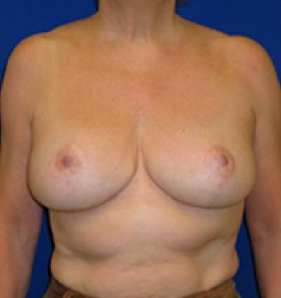 Reduction Before & After Gallery - Patient 175169627 - Image 2