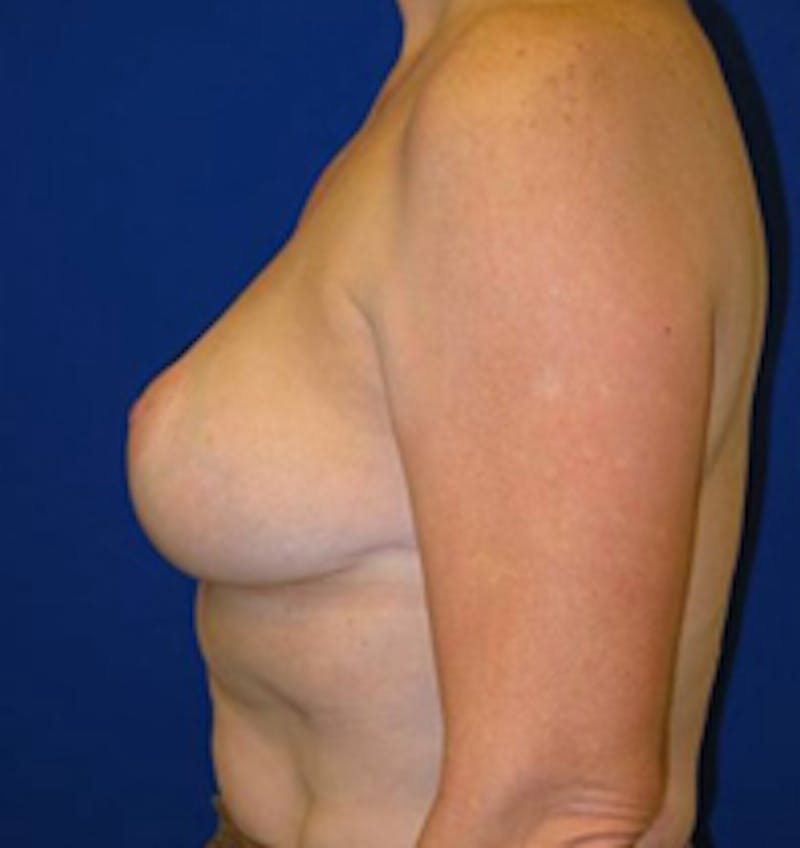 Reduction Before & After Gallery - Patient 175169627 - Image 4