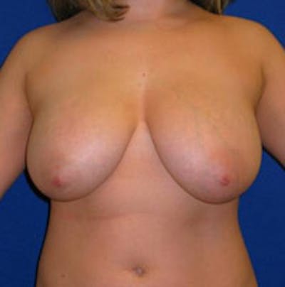 Reduction Before & After Gallery - Patient 175169629 - Image 1
