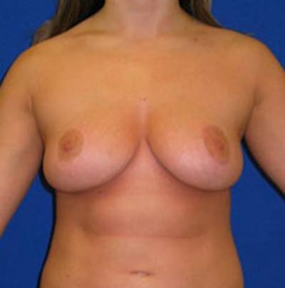 Reduction Before & After Gallery - Patient 175169629 - Image 2