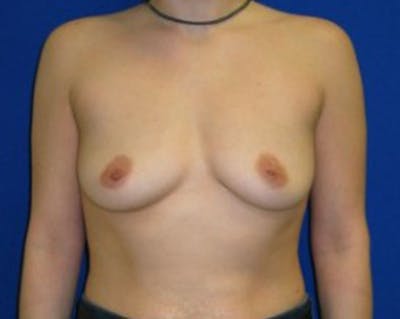Augmentation Before & After Gallery - Patient 175169630 - Image 1