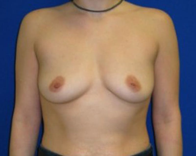 Augmentation Before & After Gallery - Patient 175169630 - Image 1