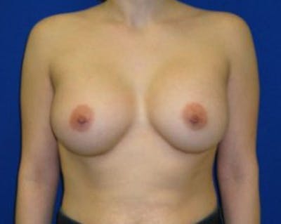 Augmentation Before & After Gallery - Patient 175169630 - Image 2