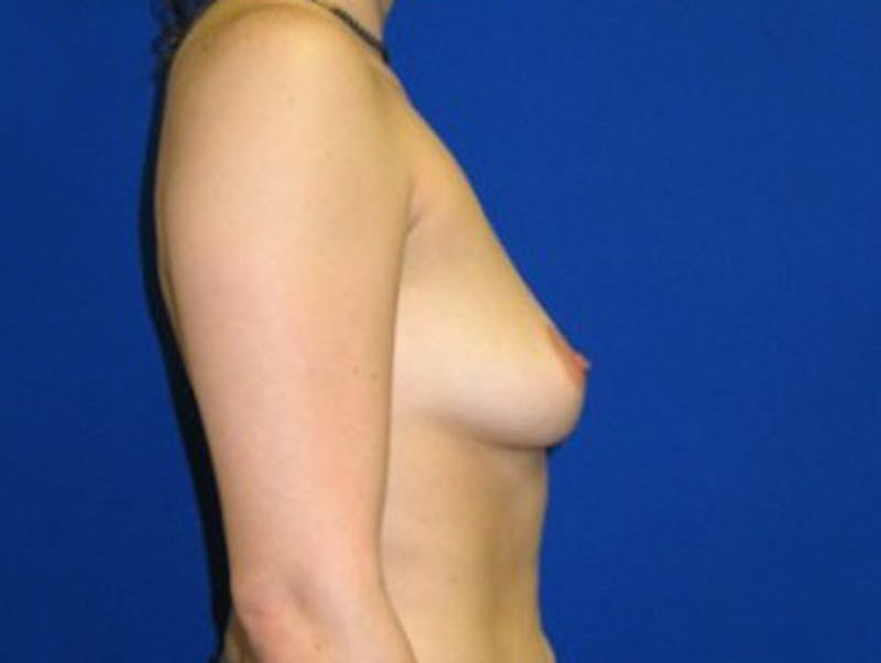 Augmentation Before & After Gallery - Patient 175169630 - Image 3
