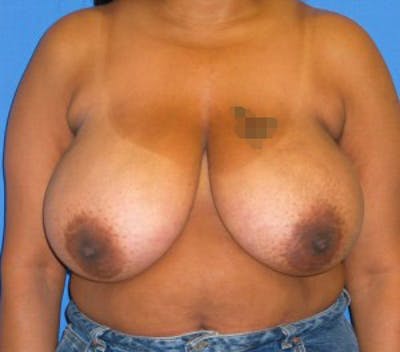 Reduction Before & After Gallery - Patient 175169635 - Image 1