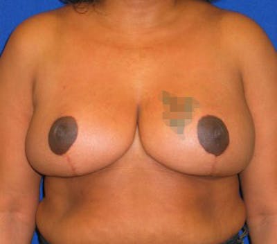 Reduction Before & After Gallery - Patient 175169635 - Image 2