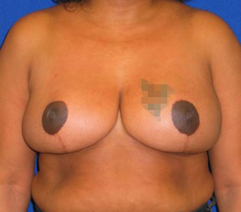 Reduction Before & After Gallery - Patient 175169635 - Image 2